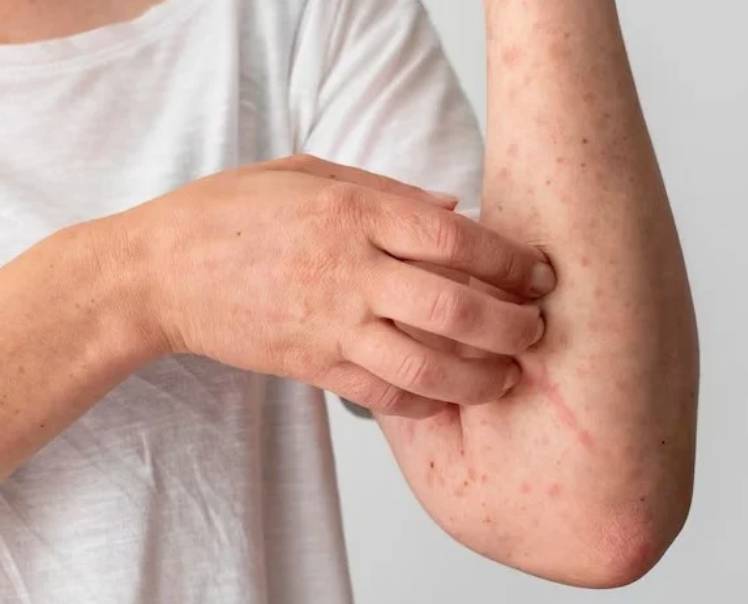 NUEVA CEPA RECOMBINANTE DE MPOX: LA OMS ALERTA SOBRE UNA VARIANTE HÍBRIDA QUE PODRÍA ESTAR MÁS DISEMINADA