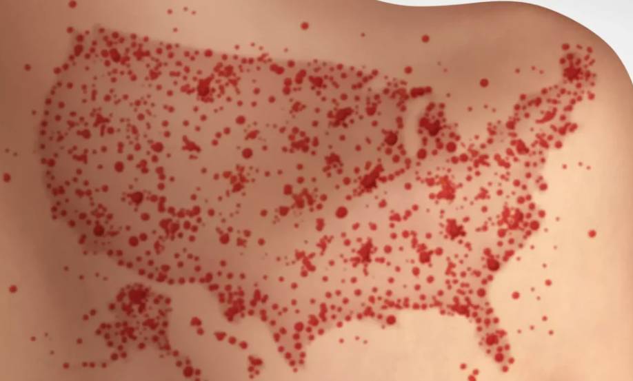 SARAMPIÓN: LA EPIDEMIA QUE EL NEOLIBERALISMO DEJÓ VOLVER