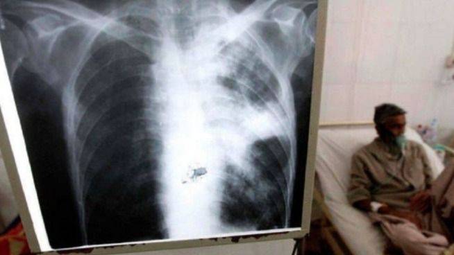 TUBERCULOSIS: LA EPIDEMIA SILENCIADA QUE AVANZA EN LA ARGENTINA NEOLIBERAL