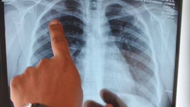 LA TUBERCULOSIS AVANZA Y LOS RECLAMOS CRECEN EN LAS ESCUELAS